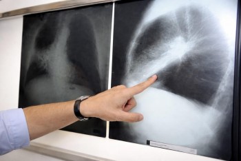 Téměř každý druhý Němec onemocní rakovinou, čísla varují i Česko